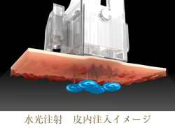 皮膚注入イメージ