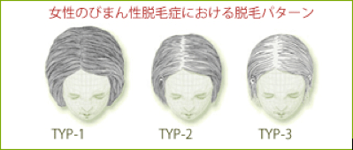 びまん性脱毛症