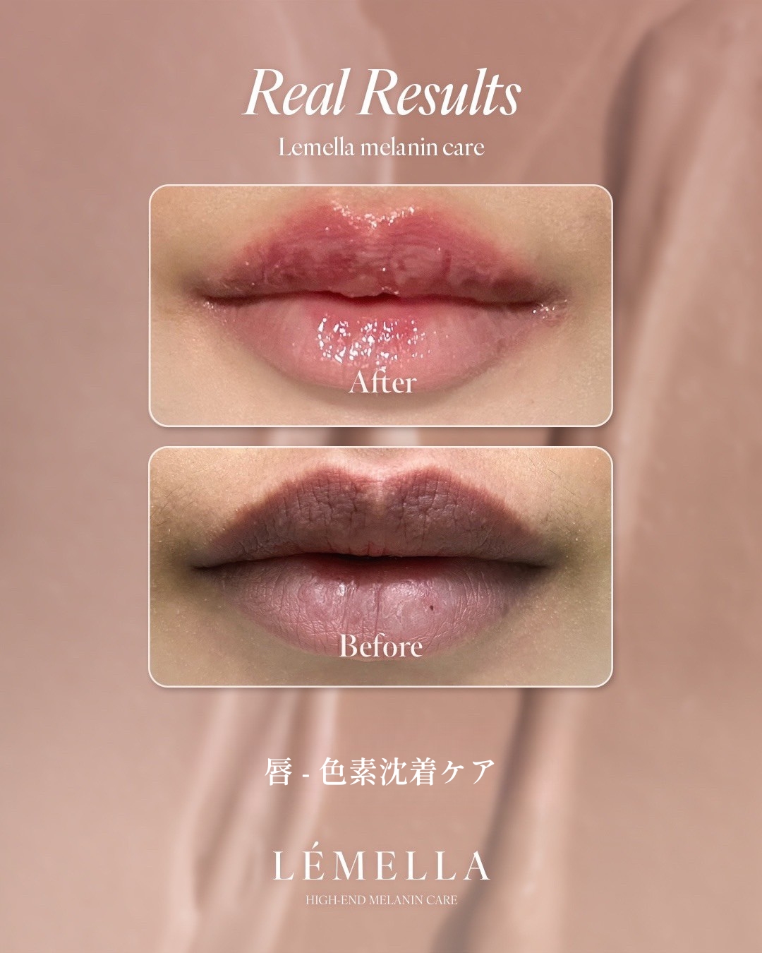 ルメラ症例写真 唇