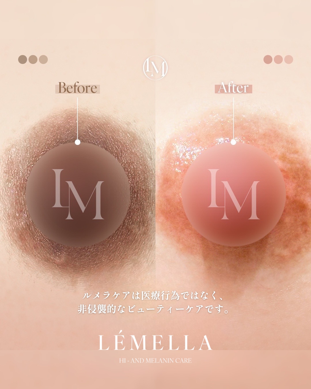 ルメラ症例写真 乳輪