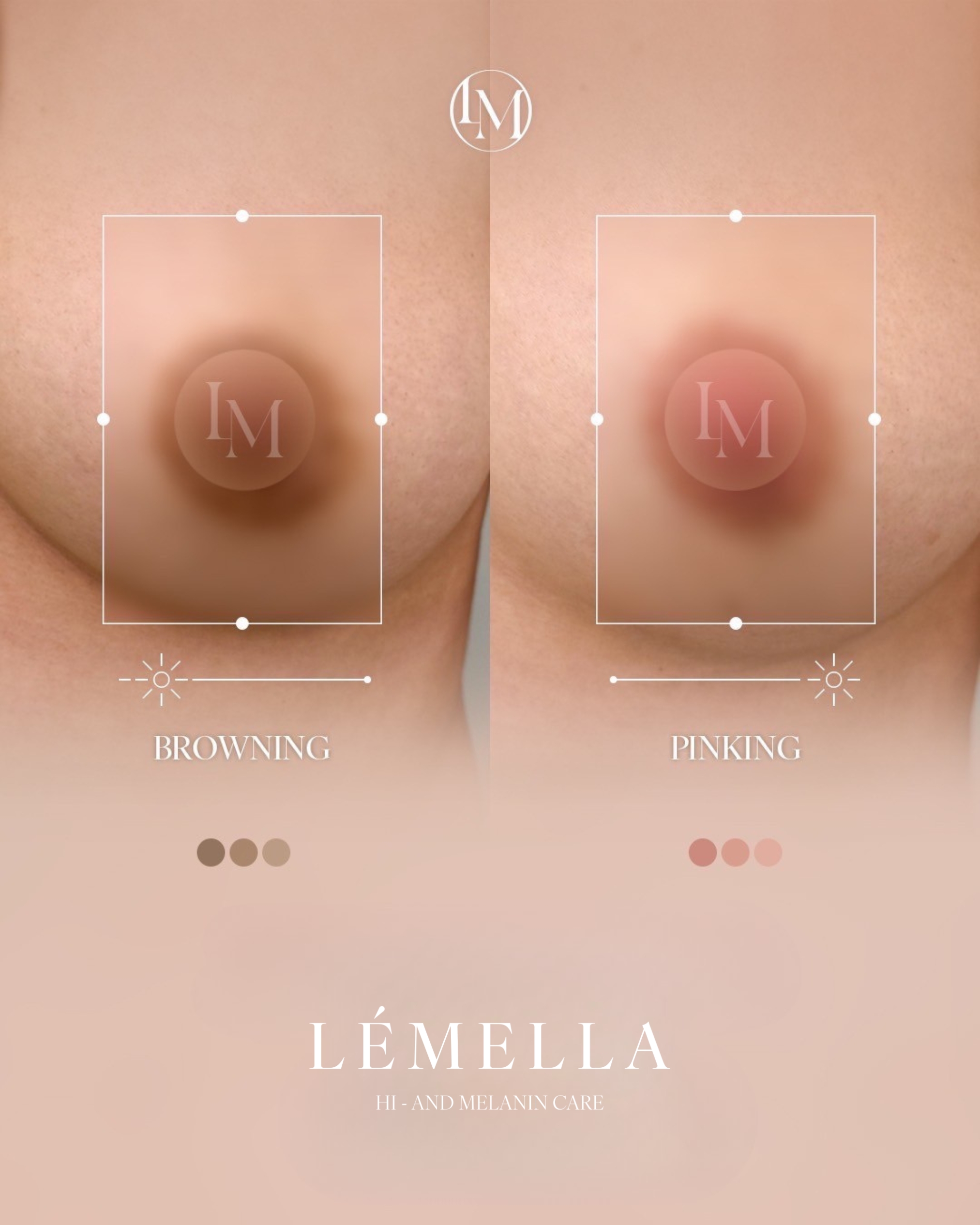 ルメラ症例写真 乳輪