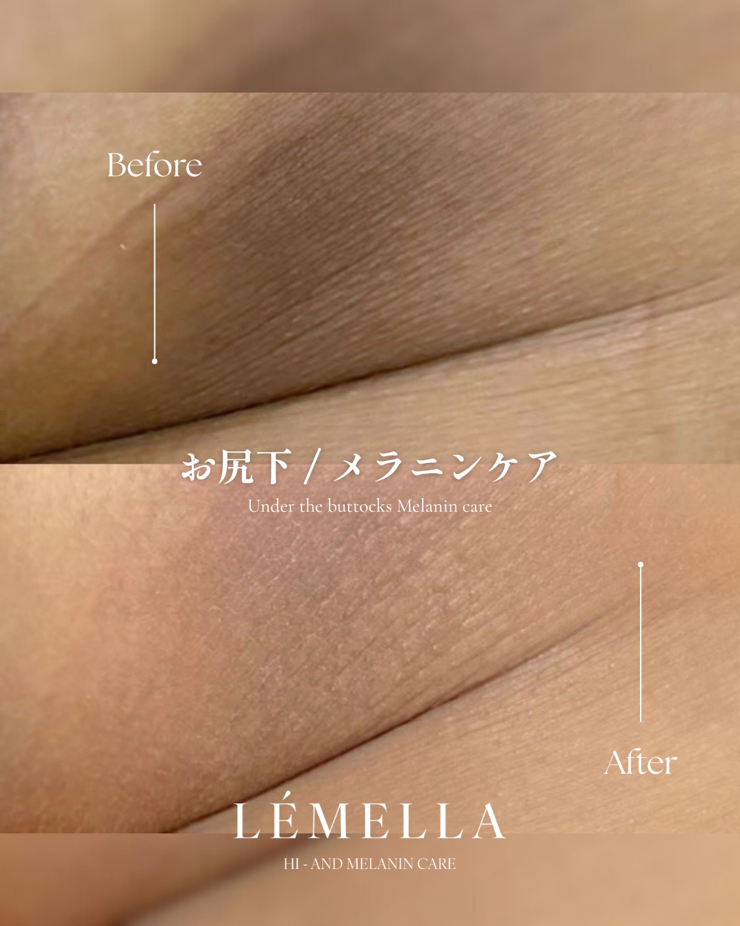 ルメラ症例写真 お尻下