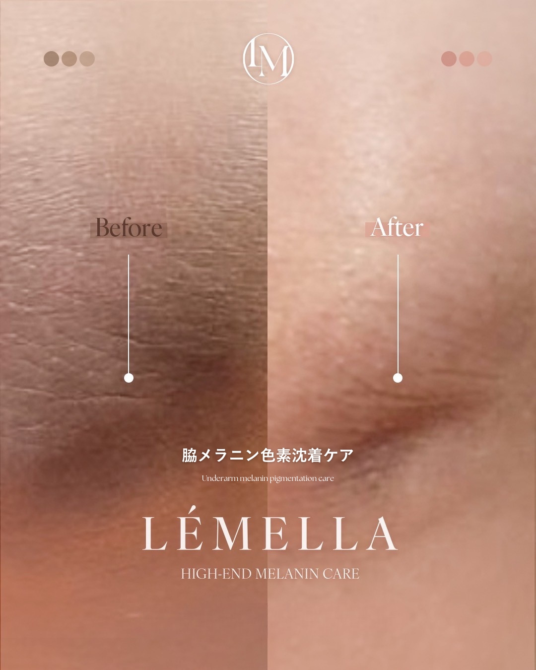 ルメラ症例写真 脇